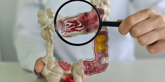 Doença inflamatória intestinal cresce 5 vezes no Brasil em 13 anos