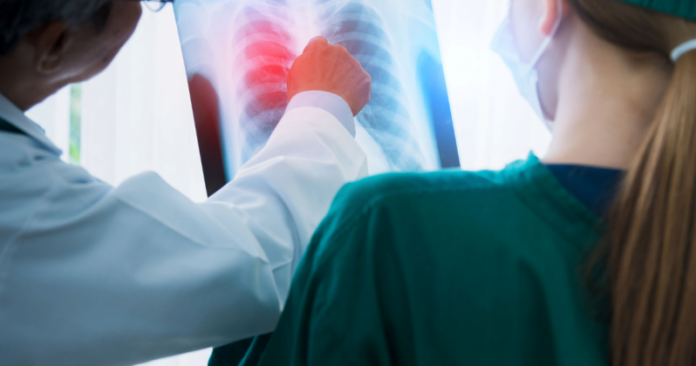 Paranavaí tem 18 casos de tuberculose em levantamento de 2026
