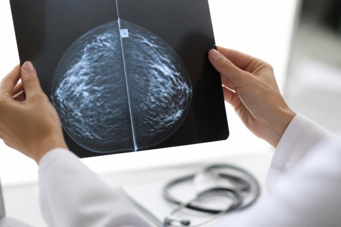 Protocolo Radnews orienta radiologistas a comunicar diagnósticos difíceis de câncer de mama
